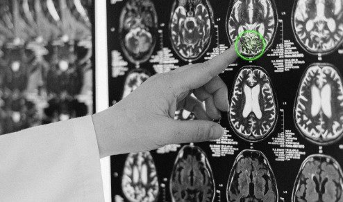 El síndrome moderno de la amígdala hiper-estimulada.